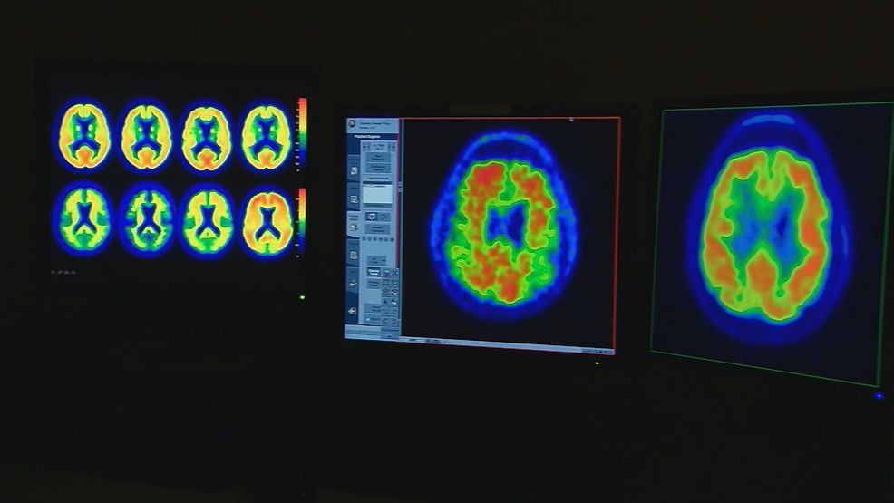 Image for story: Creatine's role in brain health: What it means for Alzheimer's patients