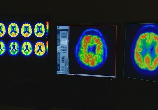 Image for story: Creatine's role in brain health: What it means for Alzheimer's patients